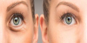 بوتاکس دور چشم