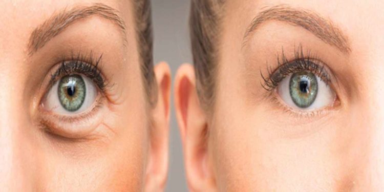 بوتاکس دور چشم