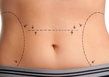 چگونه بدون جراحی لاغر شویم