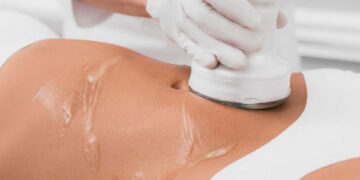 کاربرد لیپوسونیکس برای بازو، ران، پهلو و غبغب