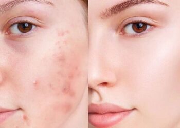 درمان جوش صورت