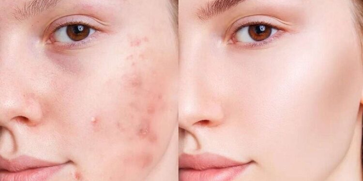 درمان جوش صورت