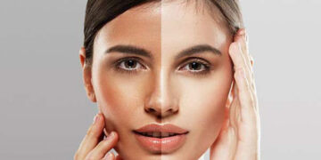 سفید شدن پوست