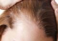 ریزش مو را چطور درمان کنیم