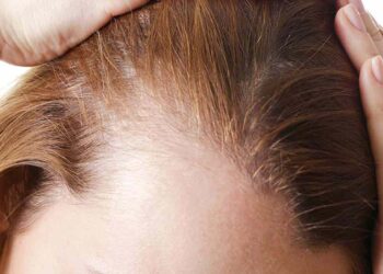 ریزش مو را چطور درمان کنیم