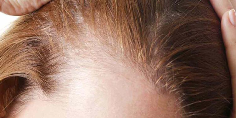 ریزش مو را چطور درمان کنیم
