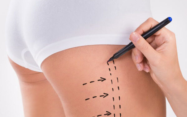 کاربرد لیپوسونیکس برای بازو، ران، پهلو و غبغب