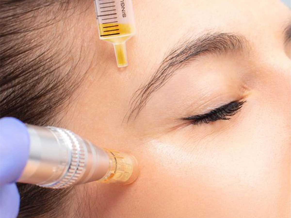 مزونیدلینگ صورت