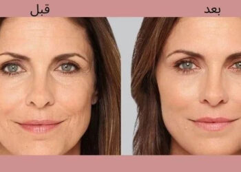 بوتاکس برای خط لبخند