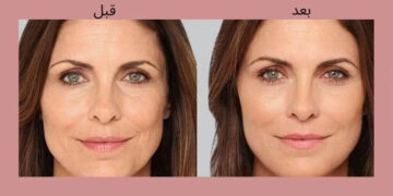بوتاکس برای خط لبخند