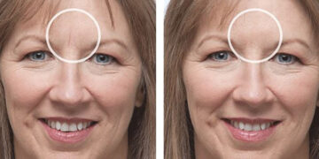 بوتاکس خط اخم عمیق