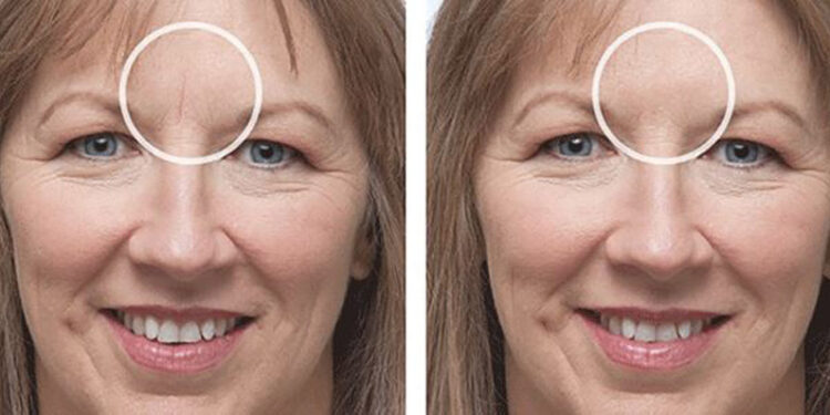 بوتاکس خط اخم عمیق