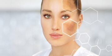 از بین بردن لک صورت فوری