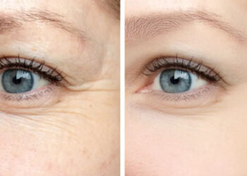 بوتاکس پنجه کلاغی