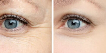 بوتاکس پنجه کلاغی