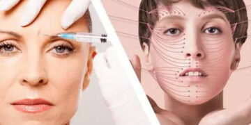 بوتاکس بهتره یا نخ
