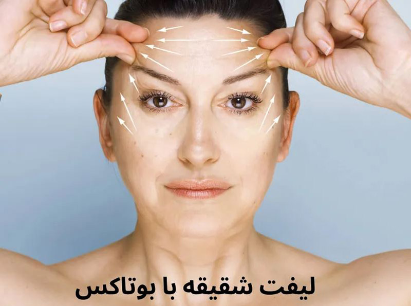 بوتاکس برای لیفت شقیقه