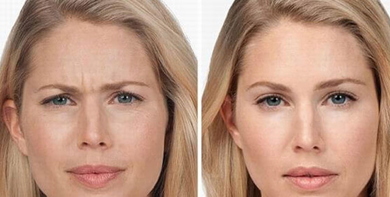 بوتاکس خط اخم عمیق