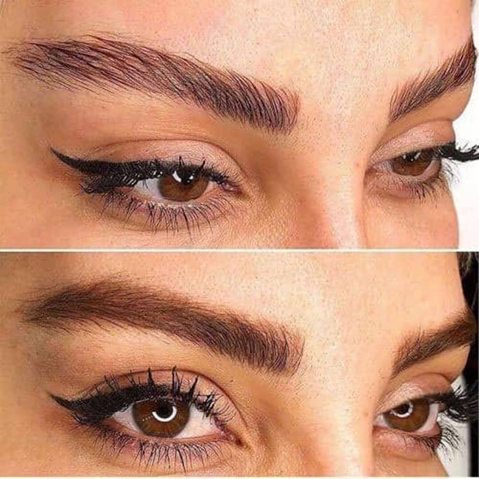 بوتاکس چشم گربه ‌ای