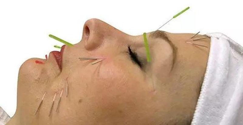 بوتاکس صورت یا طب سوزنی