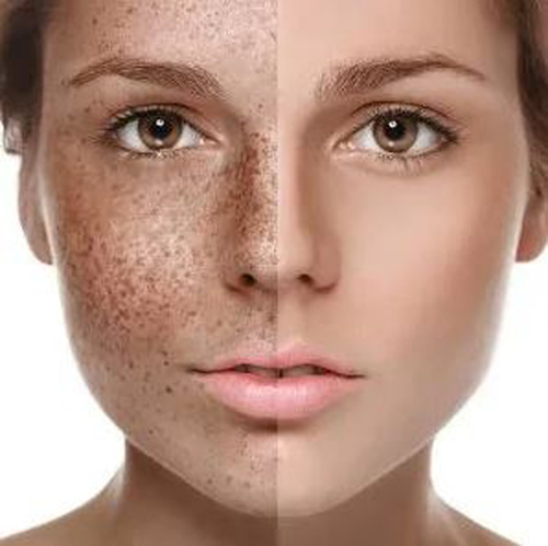 از بین بردن لک صورت فوری