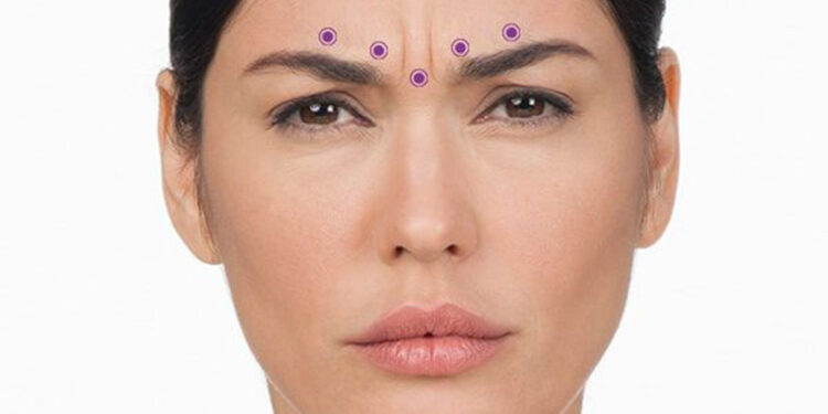 بوتاکس خط اخم یا فیلر برای خط اخم