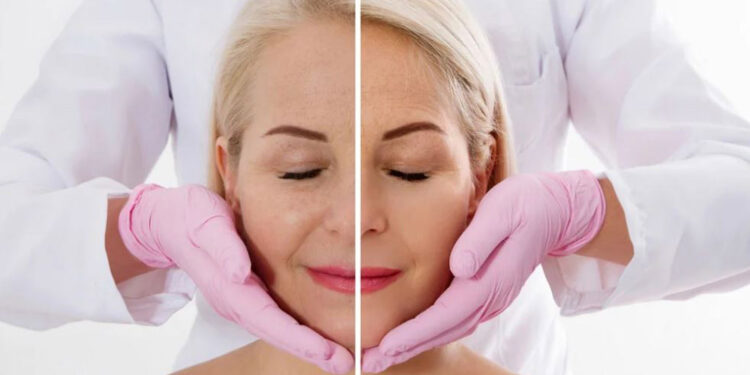 اگزوزوم صورت یا بوتاکس