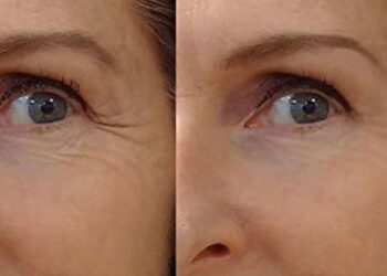 آرژیرلین رقیب بوتاکس