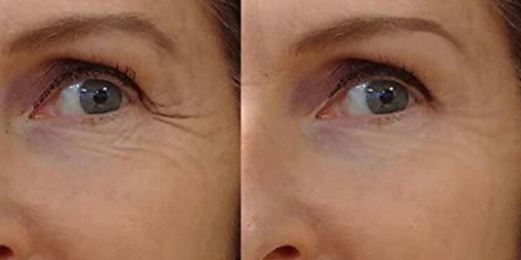 آرژیرلین رقیب بوتاکس