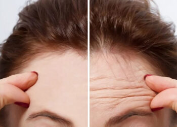 تزریق بوتاکس برای درمان چروک صورت یا تزریق NAD