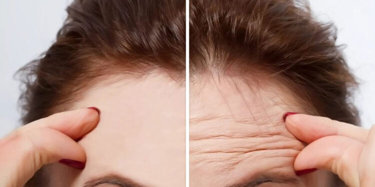 تزریق بوتاکس برای درمان چروک صورت یا تزریق NAD