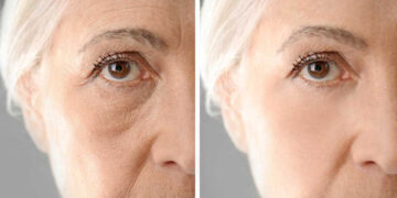 درمان چروک‌ صورت با اگزوزوم