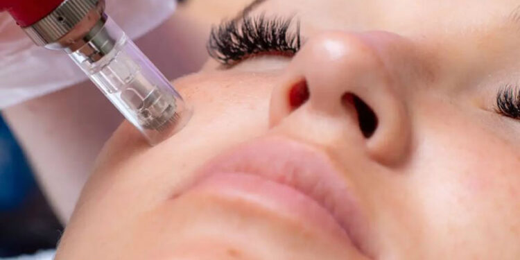 میکرونیدلینگ خانگی، تحریک کلاژن بدون بوتاکس