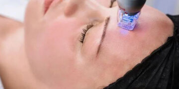 بوتاکس صورت یا میکرونیدلینگ با آر اف