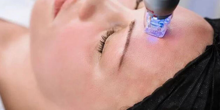 بوتاکس صورت یا میکرونیدلینگ با آر اف