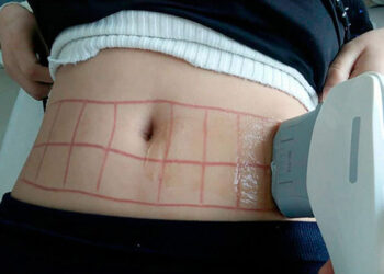 بوتاکس لاغری همراه اولتراپی