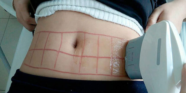 بوتاکس لاغری همراه اولتراپی