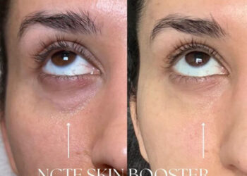 بهترین مزوژل فیلمد Filmed NCTF برای لیفت صورت