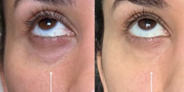 بهترین مزوژل فیلمد Filmed NCTF برای لیفت صورت