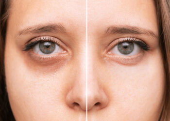 PRF انقلاب طبیعی در جوانسازی صورت