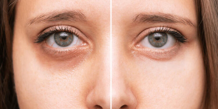 PRF انقلاب طبیعی در جوانسازی صورت