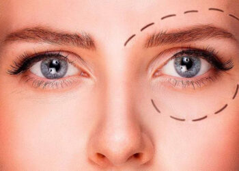 چطور میخک لیفت پلک ایجاد می‌کند