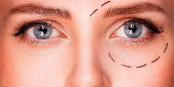 چطور میخک لیفت پلک ایجاد می‌کند