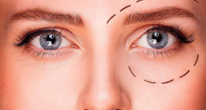 چطور میخک لیفت پلک ایجاد می‌کند