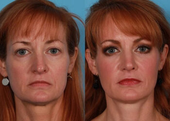 بهترین جوانساز صورت در دنیا رادیس Radiesse