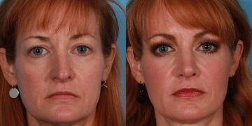 بهترین جوانساز صورت در دنیا رادیس Radiesse