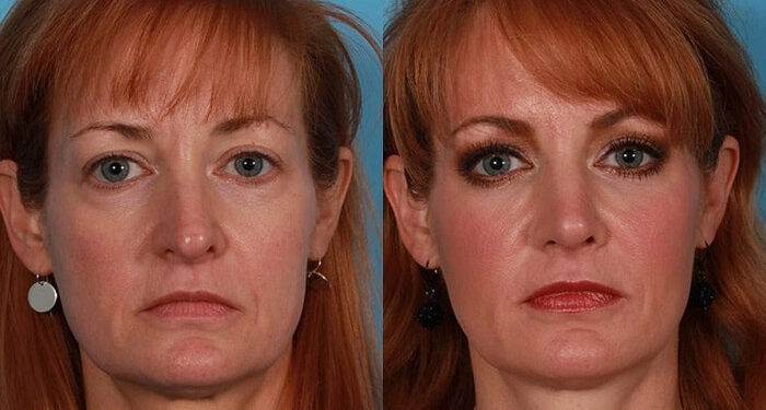 بهترین جوانساز صورت در دنیا رادیس Radiesse