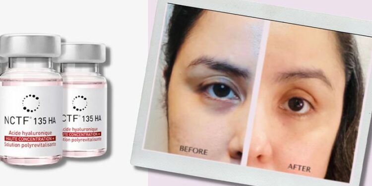 روش جوانسازی صورت ان سی تی اف