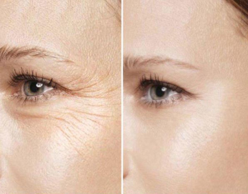 آرژیرلین رقیب بوتاکس