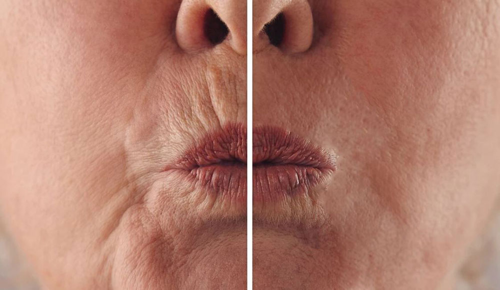 بوتاکس دور لب یا اگزوزوم